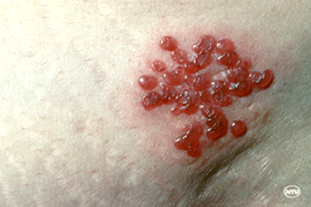 A close-up of tiny blisters from a shingles rash