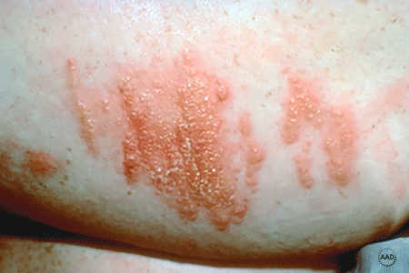 Poison ivy rash