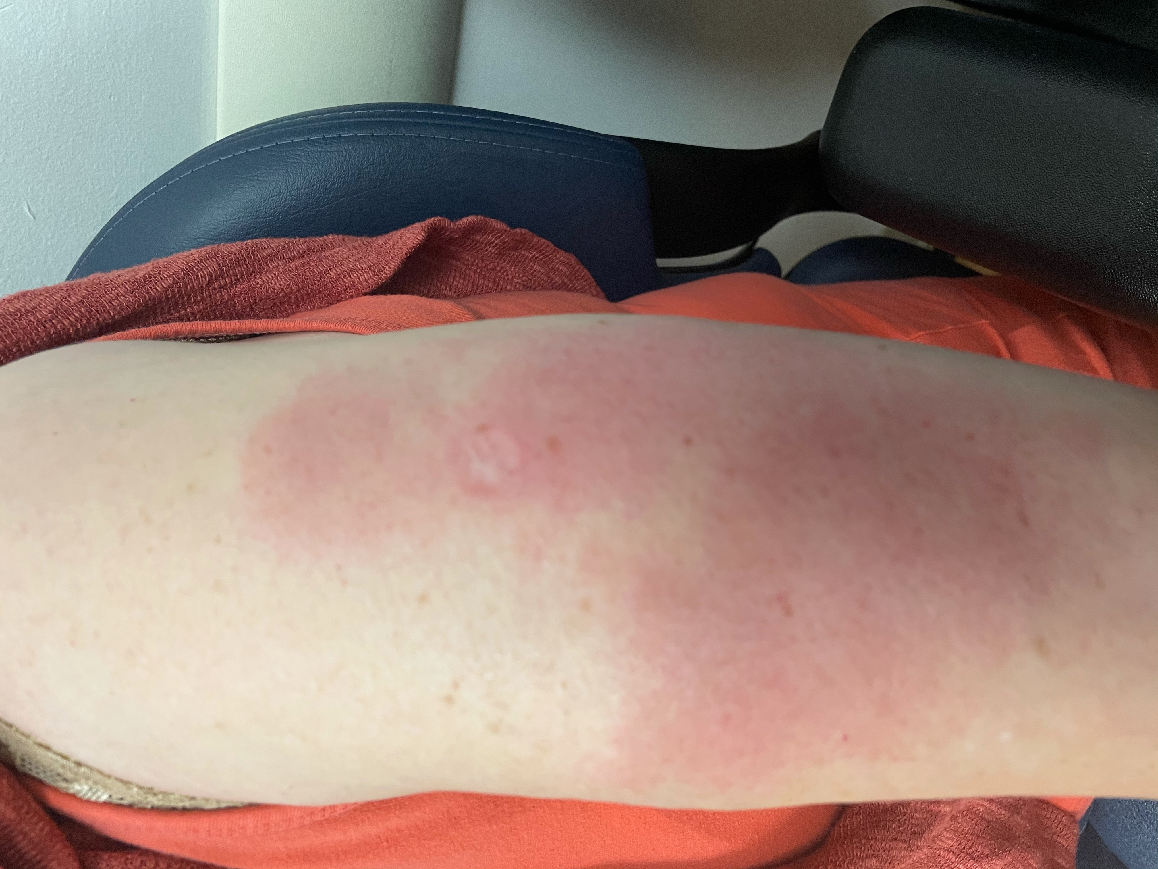 Image of patient with rash after receiving COVID-19 vaccine
