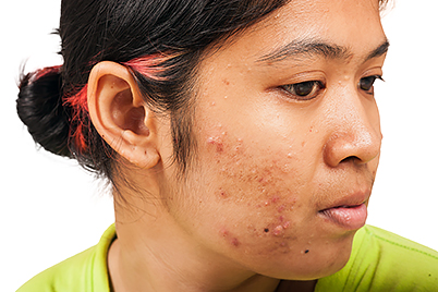 How Long Can I Take An Antibiotic To Treat My Acne