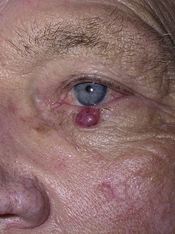 Image of a man's face with a red growth below the eye, a sign of Merkel cell carcinoma, for DWII | American Academy of Dermatology (AAD).