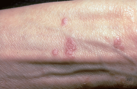 Lichen planus bumps on the wrist