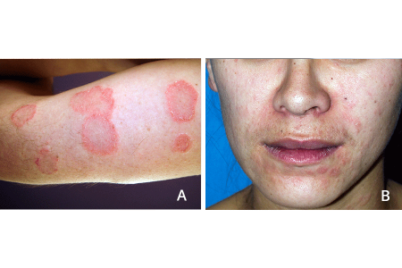 Pityriasis rosea rash that looks like ringworm (A). Pityriasis rosea rash on face that looks like acne (B).