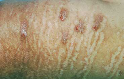 Eczema Types: Neurodermatitis Signs And Symptoms