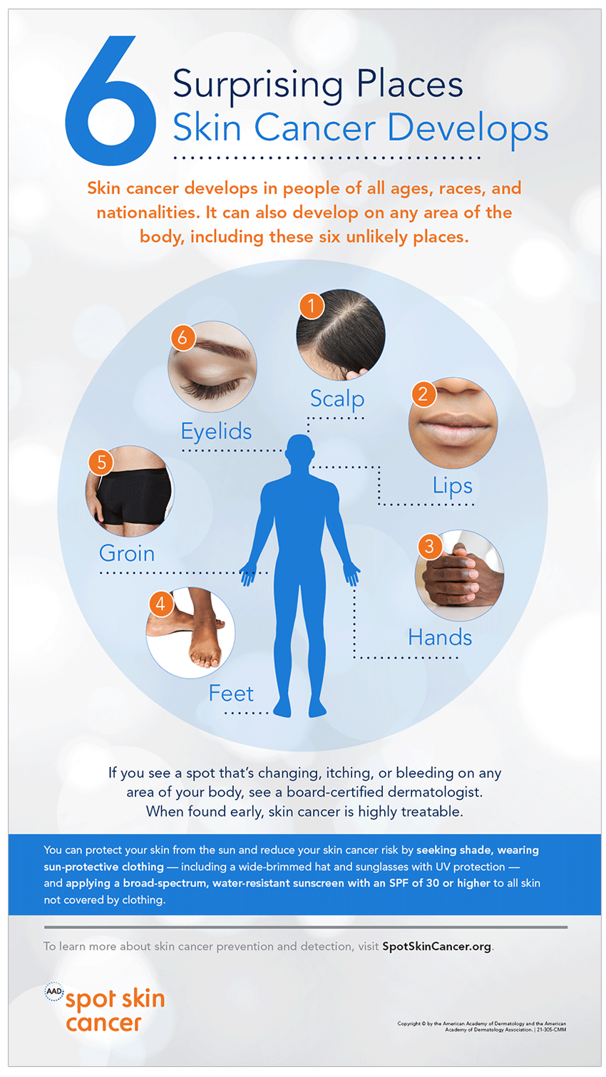 Infographic: Skin cancer develops in people of all ages, races, and nationalities. It can also develop on any area of the body, including these six unlikely places.