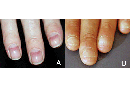 Red nails due to alopecia areata (A) and brittle nails that have split due to alopecia areata (B)
