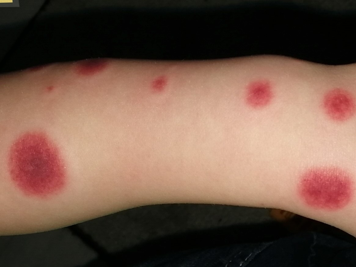 acute hemorrhagic edema of infancy