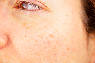 Close-up of a woman cheek with age spots caused by sun exposure