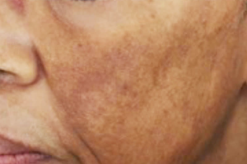 Melasma in darker skin