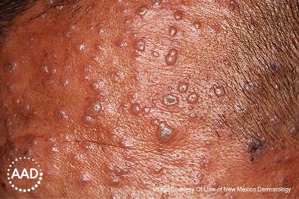 Varicella-zoster figure 2. Multiple tense vesicles and pustules, some with umbilication, on an erythematous to hyperpigmented base. Source: AAD.
