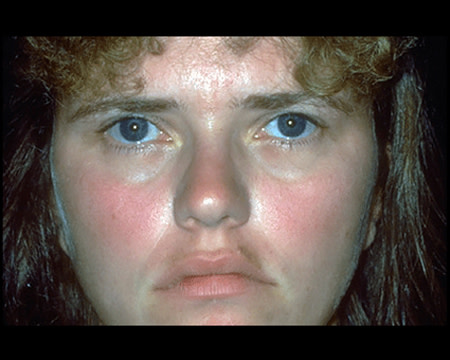rosacea on woman's face
