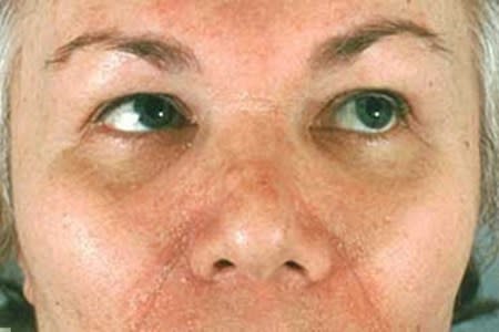 Close-up of woman with scaly patches of skin on face from seborrheic dermatitis