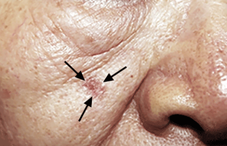 An actinic keratosis precancerous skin growth on a man's cheek