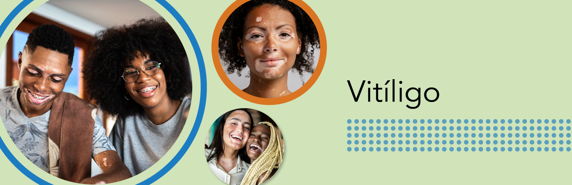Good Skin Knowledge: Lesson plans: Module 11: Vitiligo - Spanish hero image