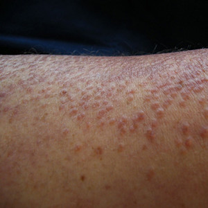 Card image of cutaneous signs of monoclonal gammopathy