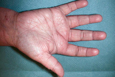 An increased number of lines on person’s palm due to atopic dermatitis