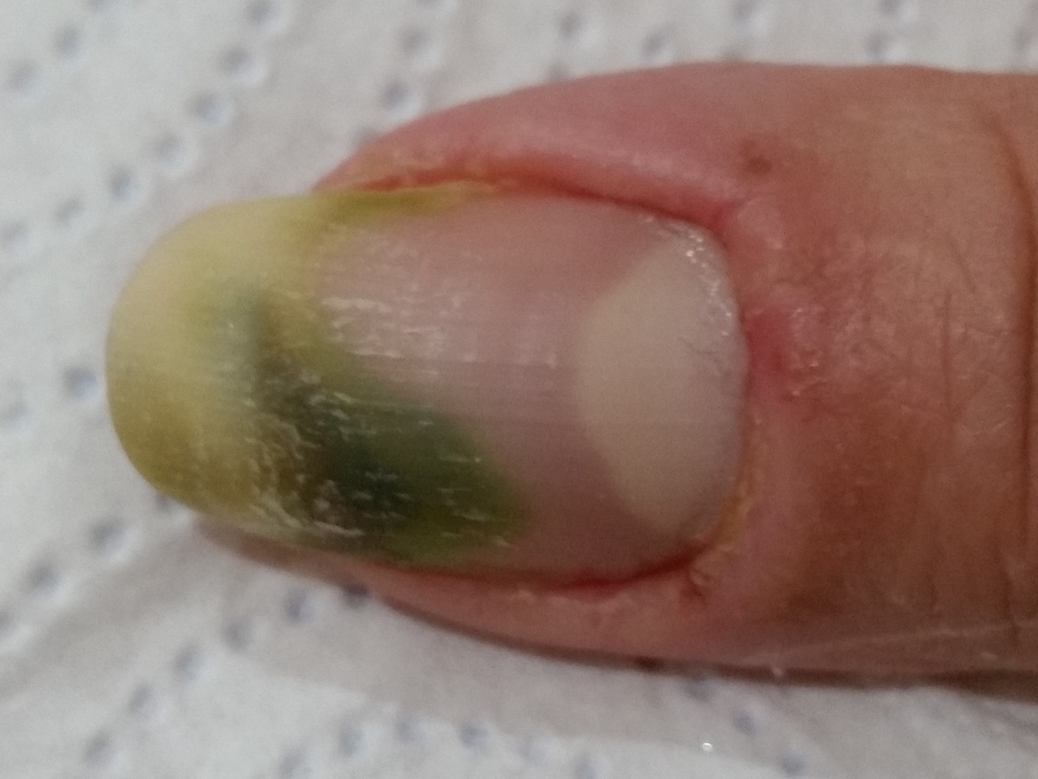Illustration for DWII on green nail syndrome