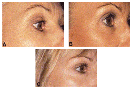 Woman before and after treatment for sun-damaged skin
