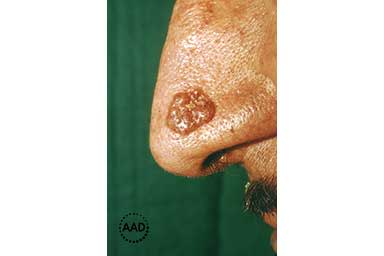 Brown, warty nodular basal cell carcinoma on nose | American Academy of Dermatology