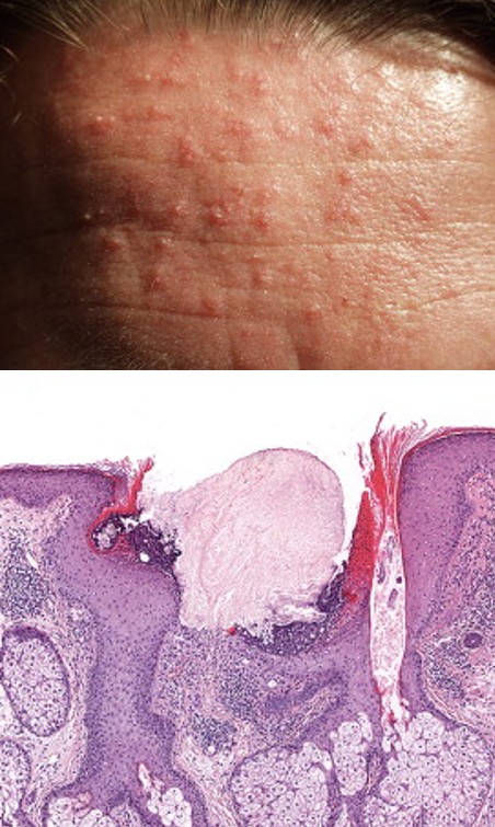 Images for DWII of necrotizing infundibular crystalline folliculitis on the skin and under the microscope