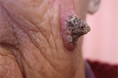 The growth that’s shaped like a rhinoceros horn and is growing on this elderly man’s cheek is squamous cell carcinoma | American Academy of Dermatology (AAD).