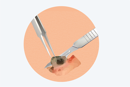 Card illustration for shave removals