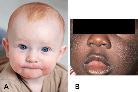 Atopic dermatitis on cheeks of baby with lighter skin tone and on face of baby with darker skin tone
