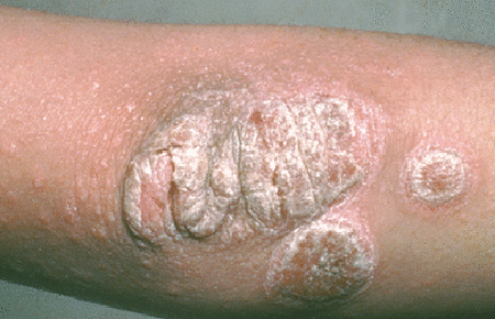 psoriasis on the elbow