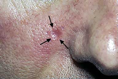 Pinkish dip near this patient’s nose is basal cell carcinoma | American Academy of Dermatology