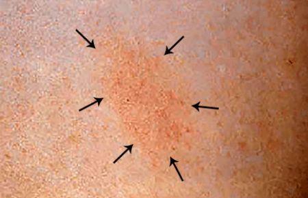 Patch granuloma annulare on skin