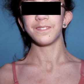 Card image for DWII on Turner Syndrome, image of a female with lighter skin tone