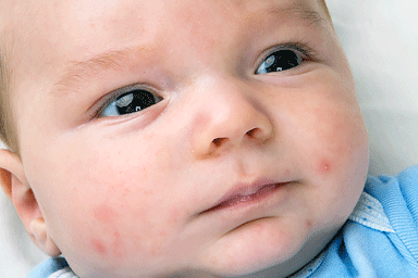 Close up of newborn baby's face with red rash acne and pimples commonly known as baby acne.
