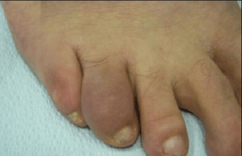 psoriatic arthritis toes