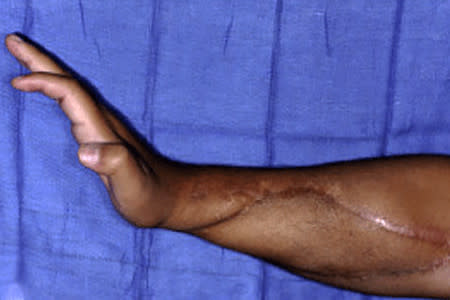 A contracture scar on a man's forearm