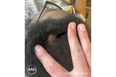 A growth on this woman’s scalp is a type of skin cancer called squamous cell carcinoma | American Academy of Dermatology (AAD).