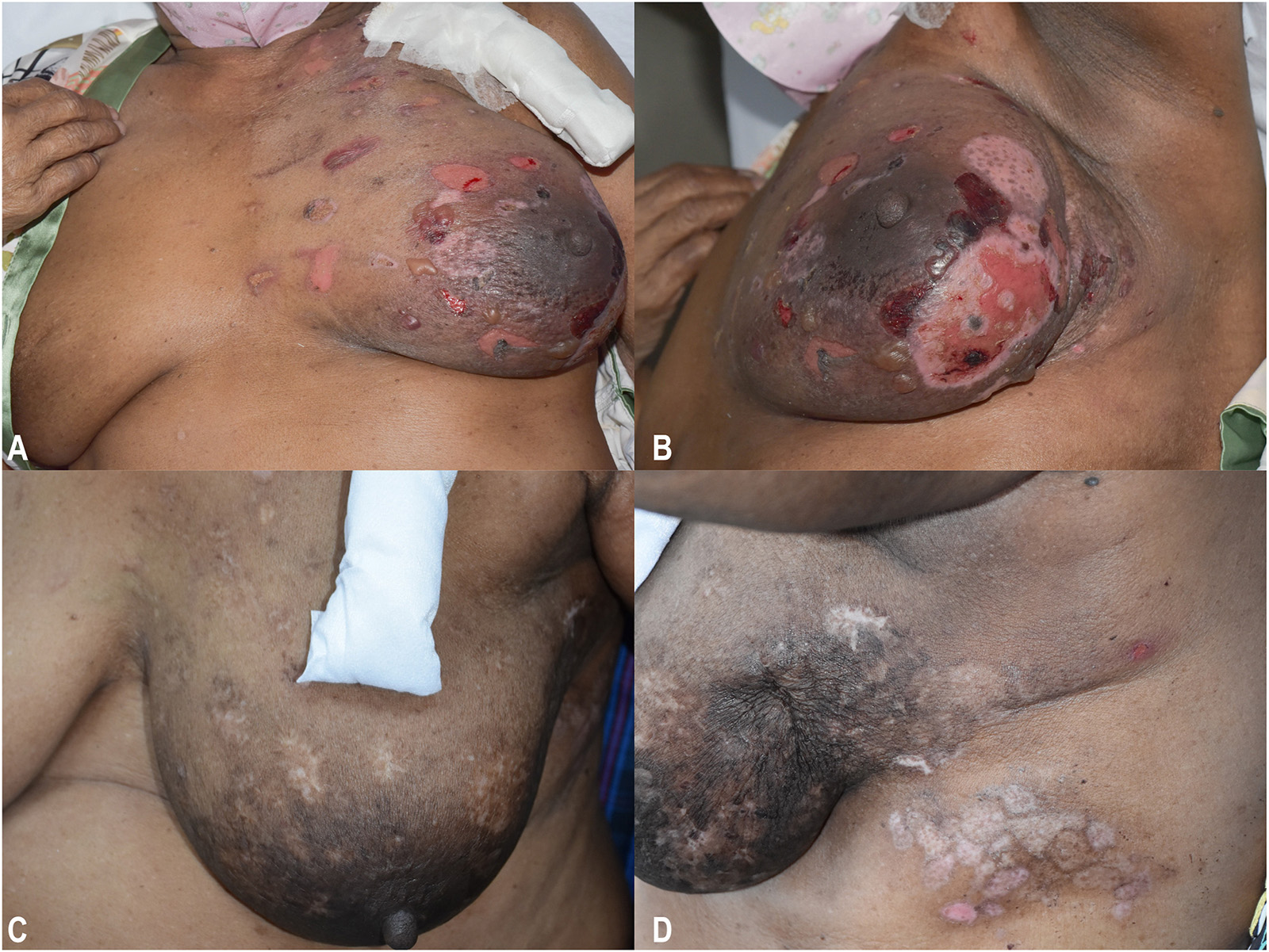 Image of bullous pemphigoid related to radiation therapy