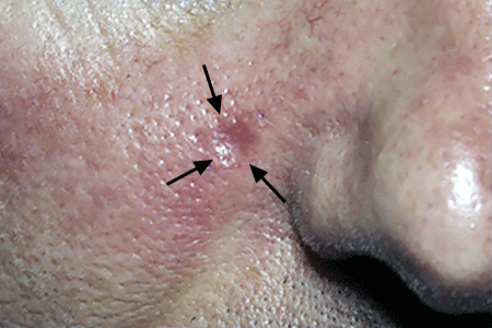 Reddish basal cell carcinoma on patient’s face 
