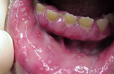 First cold sore outbreak in a young child's mouth