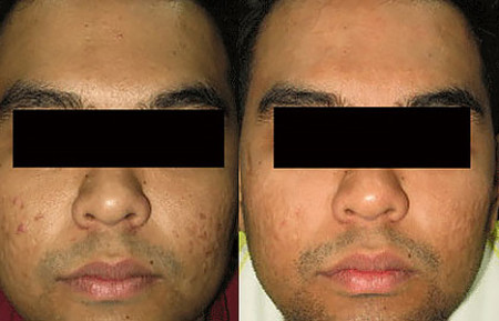Fade dark spots in skin of color: Before and after clinical image
