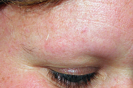 Loss of eyebrow due to alopecia areata