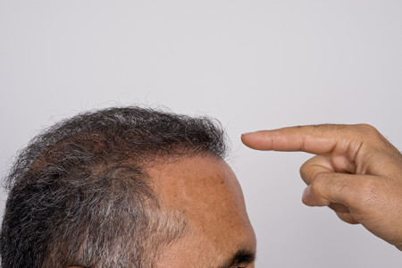 How to treat hair loss