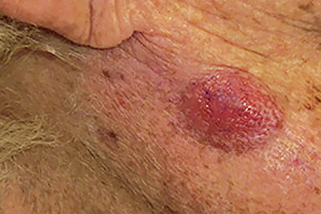 A growing, bleeding spot on the jawline of this patient is Merkel cell carcinoma