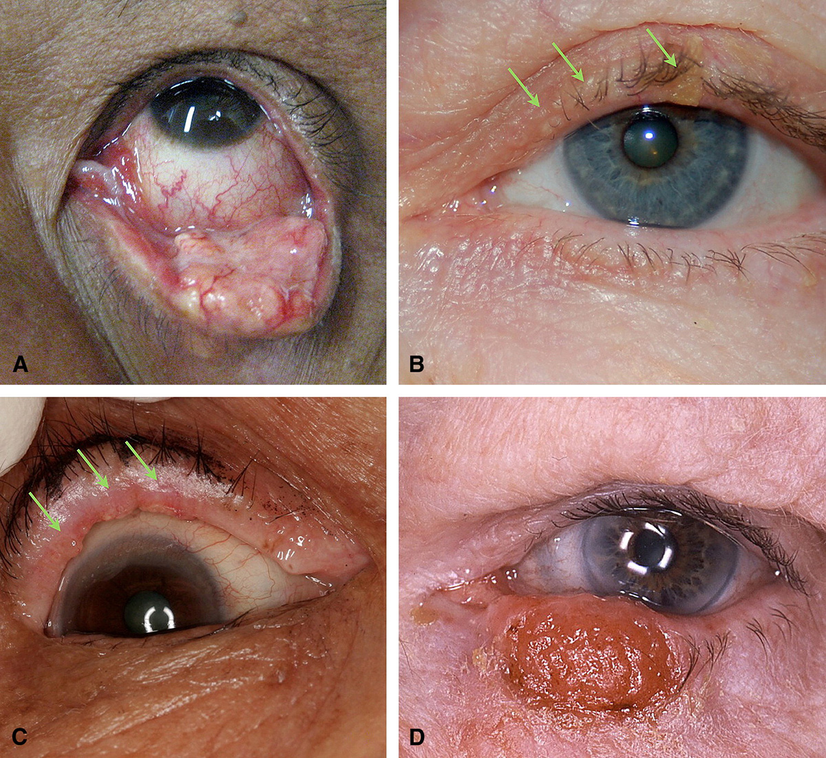 Image for DWII of sebaceous carcinoma, showing four images of the eye
