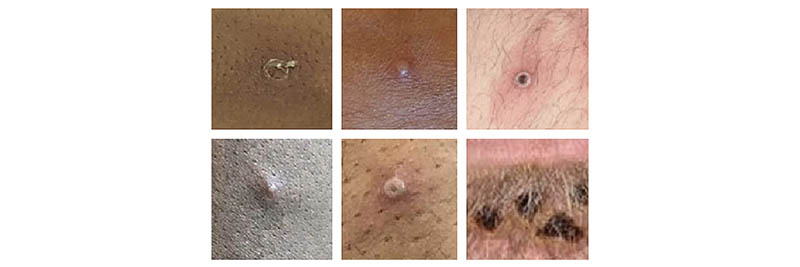 AAD’s work with CDC on mpox guidance demonstrates dermatology’s expertise 