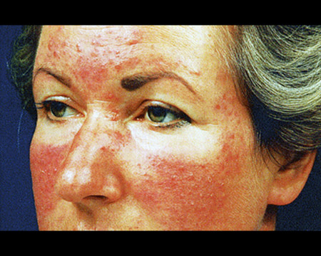 rosacea on woman's face