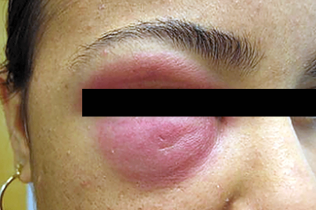 Swollen eyelid from lupus