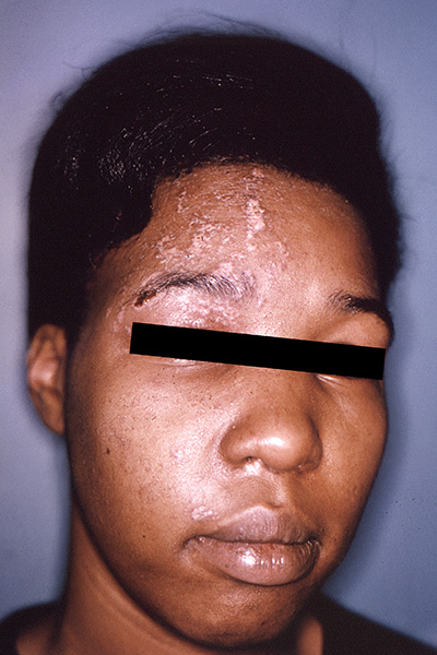 Varicella-zoster figure 5. A patient with pustulovesicles in a V1 dermatomal distribution accompanied by periorbital edema. Source: CDC. (11)