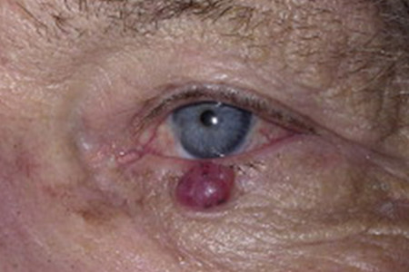 Merkel cell carcinoma is a type of skin cancer that can look like a fast-growing bump or sore.