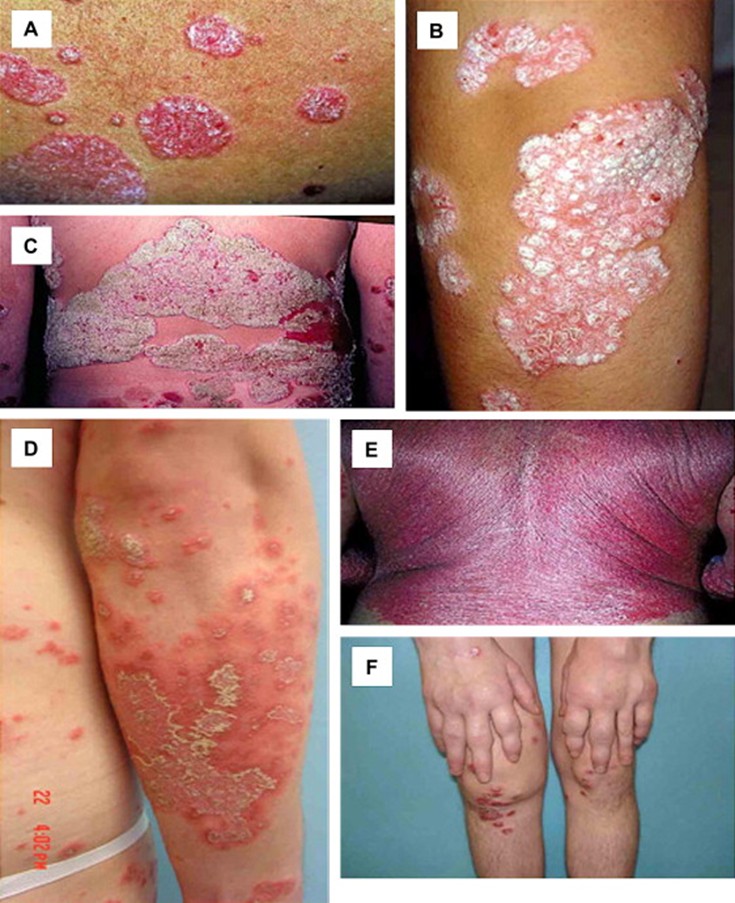 Image for DWII is from JAAD 2008 May;58(5):826-50