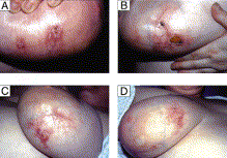 Image for DWII on diffuse dermal angiomatosis